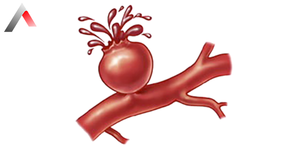 Aort_Y__rt__lmas___Nedir_ada88f8f.webp