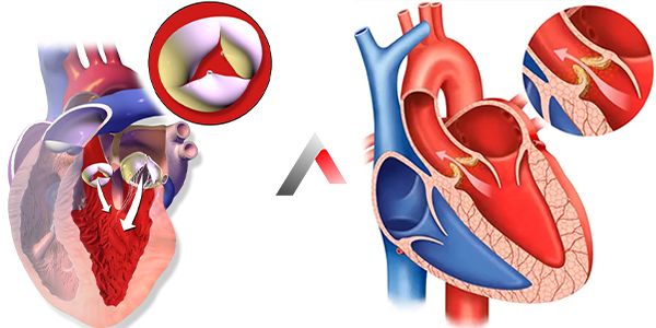 Aort_Yetmezli__i_Nedir_000644d7.webp