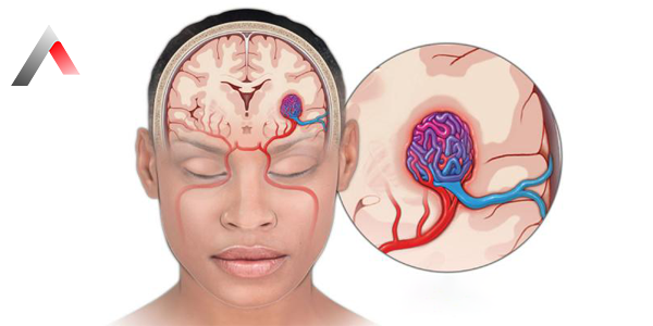 Arterioven__z_Malformasyon_6008ebc7.webp