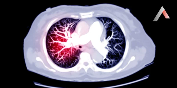 Arteriyel_Emboli_c73e9867.webp