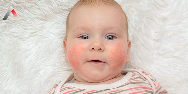 Atopik_Dermatit_30b9be23.webp
