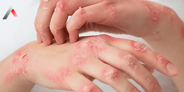 Atopik_Dermatit_Nedir_9a009e69.webp