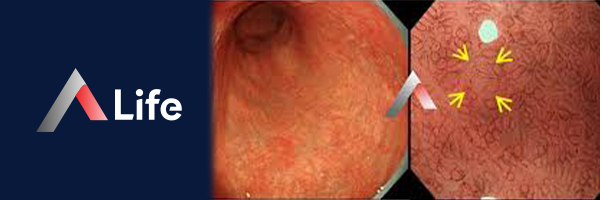 Atrofik_Gastrit_Neden_Olur_f2e76d22.webp