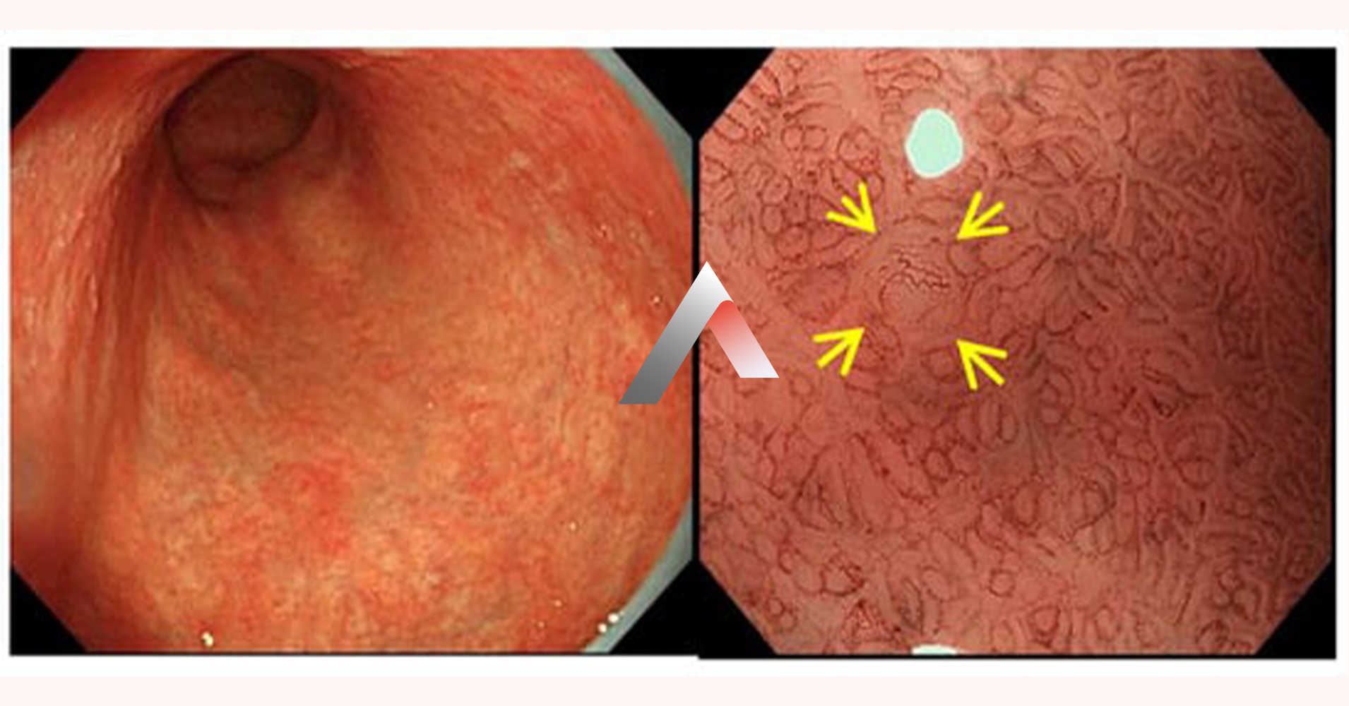 Atrofik_Gastrit_cb07a18a.webp