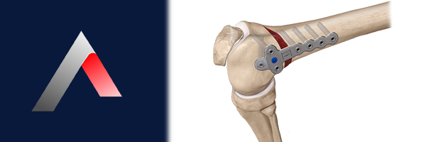 D______k_Femoral_Osteotomi_a578cba1.webp