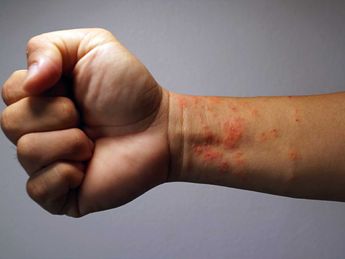 Dermatit_A__r__s___3ff6d4aa.webp