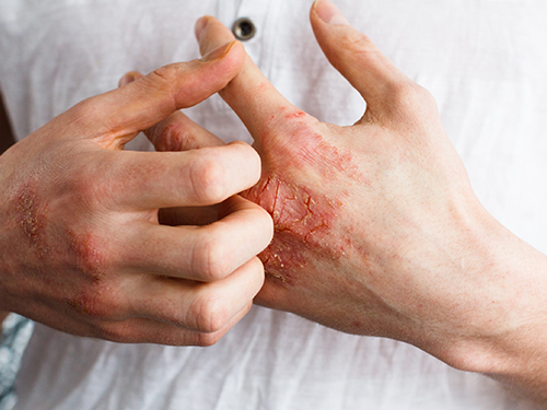 Dermatit_Ka____nt__s___5f08883b.webp