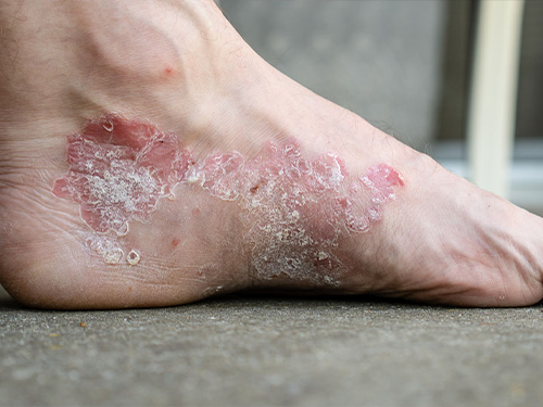 Dermatit_Kabarc__k_ve_Pullanma_75e5a77c.webp