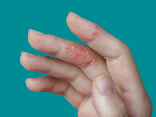 Dermatit_Kuruluk_ve_Pul_Pul_D__k__lme_176c1c1a.webp