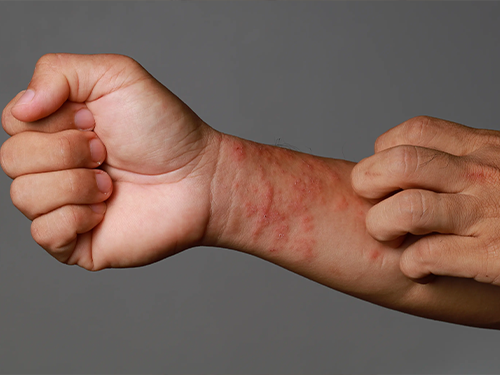 Dermatit_e9fbea3d.webp