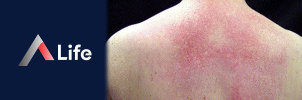 Dermatomiyozit_ab19ea2c.webp