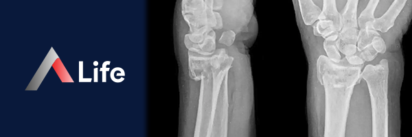 Distal_Radius_K__r_______097ad445.webp