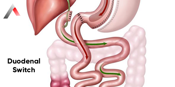 Duodenal_Switch_21462ac3.webp