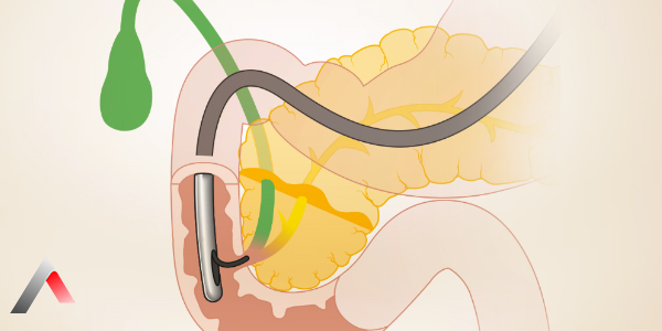 ERCP_d8528c8e.webp