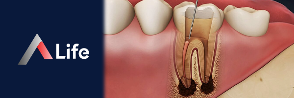 Endodonti_d0832ba8.webp