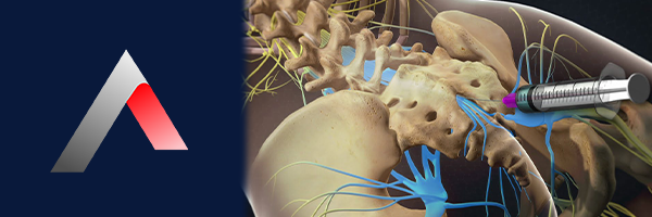 Epidural_Steroid_Enjeksiyonu_c9df7fa6.webp