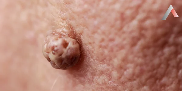 FIBROMA_NEDIR__c6ad2dd8.webp
