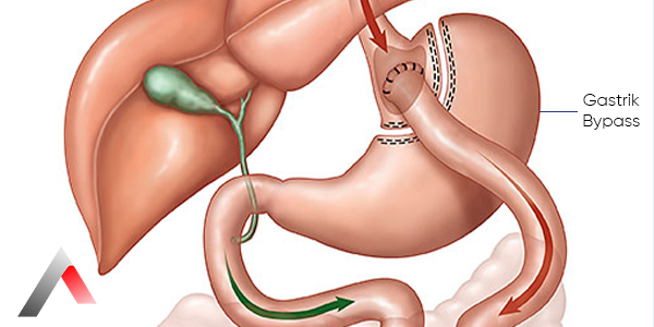 Gastrik_Baypas_15d1ebb3.webp