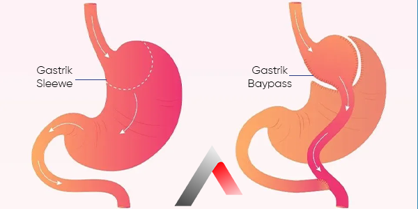 Gastrik_Baypass_42645b58.webp