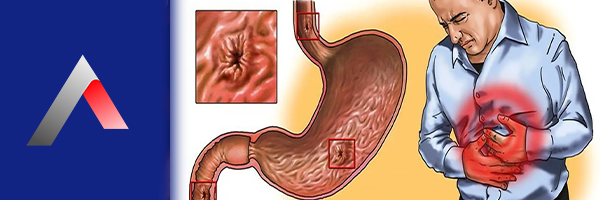 Gastrit_Nedir_4386854d.webp