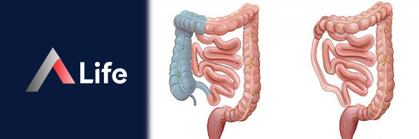 Hemikolektomi_Nedir_0c3e1eef.webp