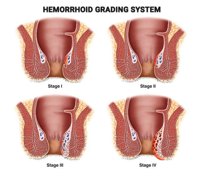 Hemoroid_Nedir_6145ce1d.webp