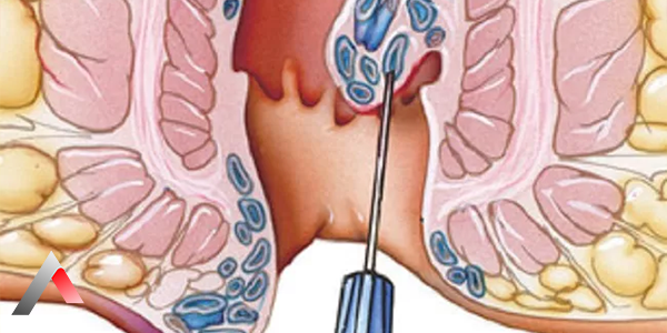 Hemoroid_Skleroterapi_47726b33.webp