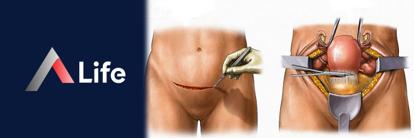 Histeroktomiii_403ec4c3.webp