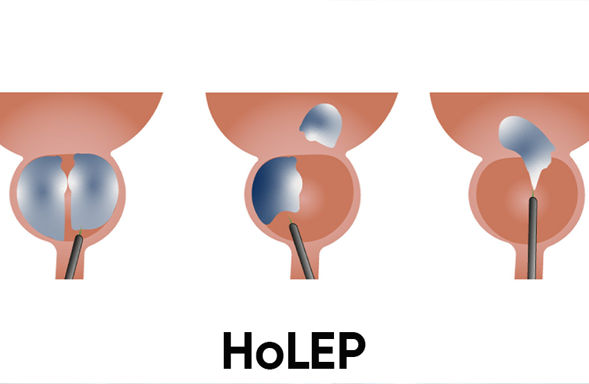 HoLEP_296ab997.webp