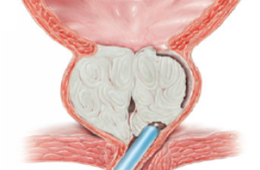 HoLEP_Y__ntemi_1e203036.webp