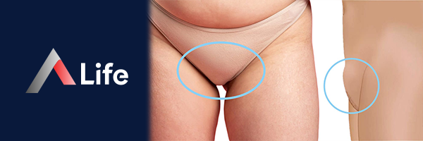Kas__k_Liposuction____d293bb95.webp
