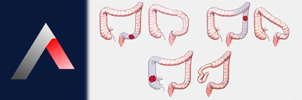 Kolektomi_a225b959.webp