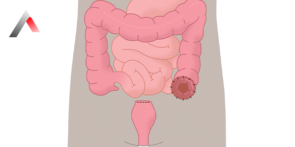 Kolostomi_ad932e4e.webp