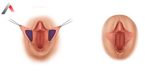 Labioplasti_76c5281d.webp