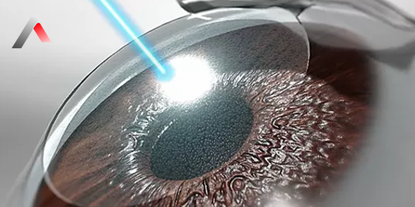 Lasik_G__z_Lazer_314a02cd.webp