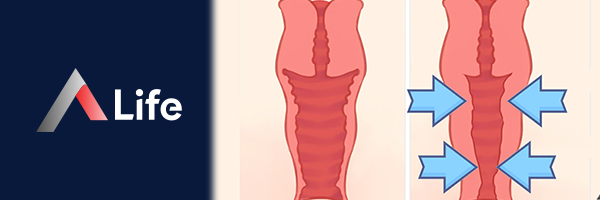 Lazer_ile_Genital_613570a6.webp