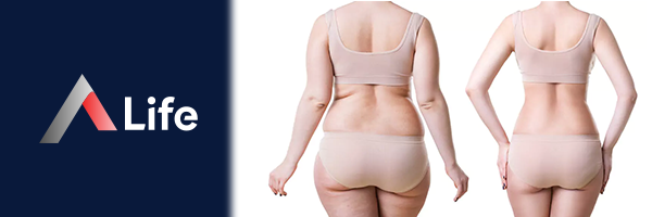 Liposuction_Nedir_552008ee.webp