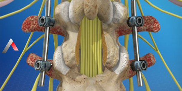 Lomber_Spinal_Fizyon_83c3007c.webp
