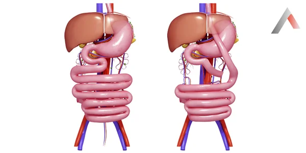 Metabolik_Cerrahi____eker_Hastal_______Ameliyat____Nedir_bcfeec2f.webp