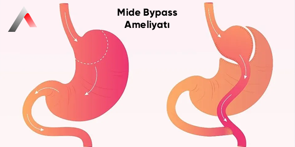 Mide_Bypass_Ameliyat___1392c620.webp
