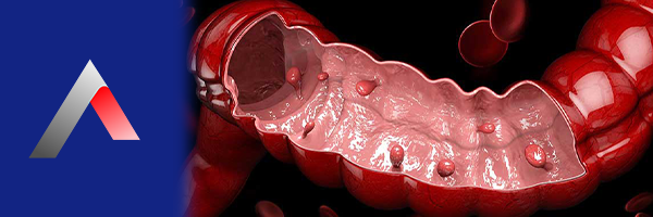 Mide_Polip_Nedir_4dbb27c0.webp