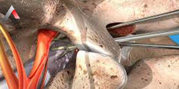 Mikrodiskektomi_af35457c.webp