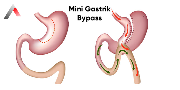 Mini_Gastrik_Bypass_de7d7163.webp