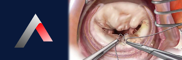 Mitral_Kapak_c01d365f.webp