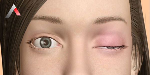 Myastenia_Gravis_Nedir_40fa7fea.webp