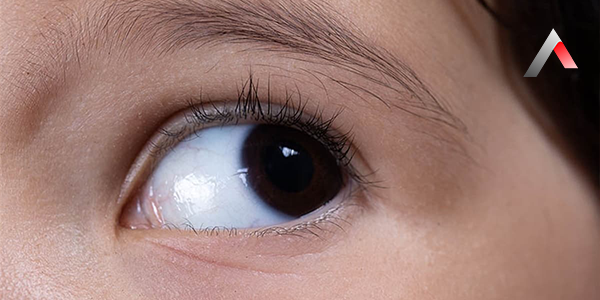 Nistagmus_Nedir_f51b6129.webp