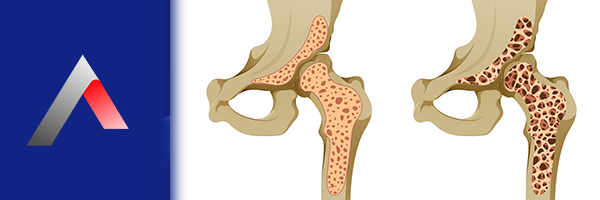 Osteomalazi_cc081b41.webp