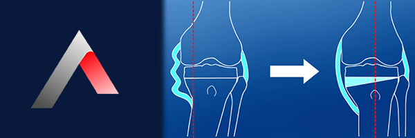 Osteotomi_d4aab7fd.webp