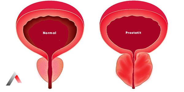 Prostatit_c238d5bc.webp