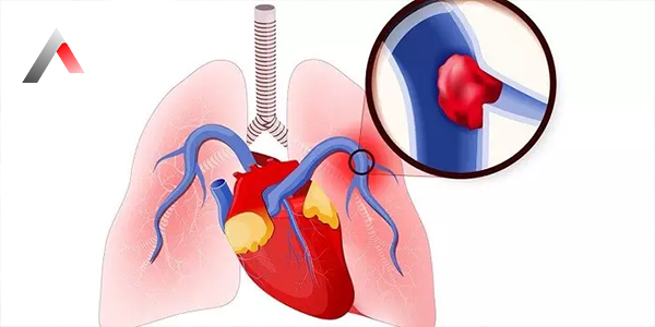 Pulmoner_Emboli_36b4c2c1.webp
